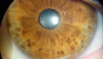 Los NÓDULOS DE LISCH son hamartomas (sobrecrecimientos del tejido normal) del iris que son patognomónicos de la NEUROFIBROMATOSIS TIPO I (Enfermedad de von Recklinghausen).