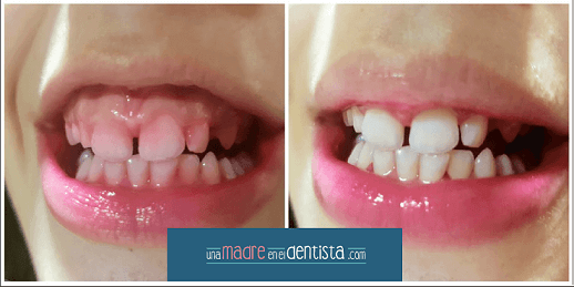 madreendentista's tweet photo. De color rojo, azul o lila: el revelador de #placa #bacteriana nos chiva dónde está el #biofilm y dónde debemos cepillar mejor.
Ah! y a los niños les encanta usarlo.
#educaciondental #tipsdentales #dentistadivertido https://t.co/7LL6eE0IRK https://t.co/Lc10Z3sCXO