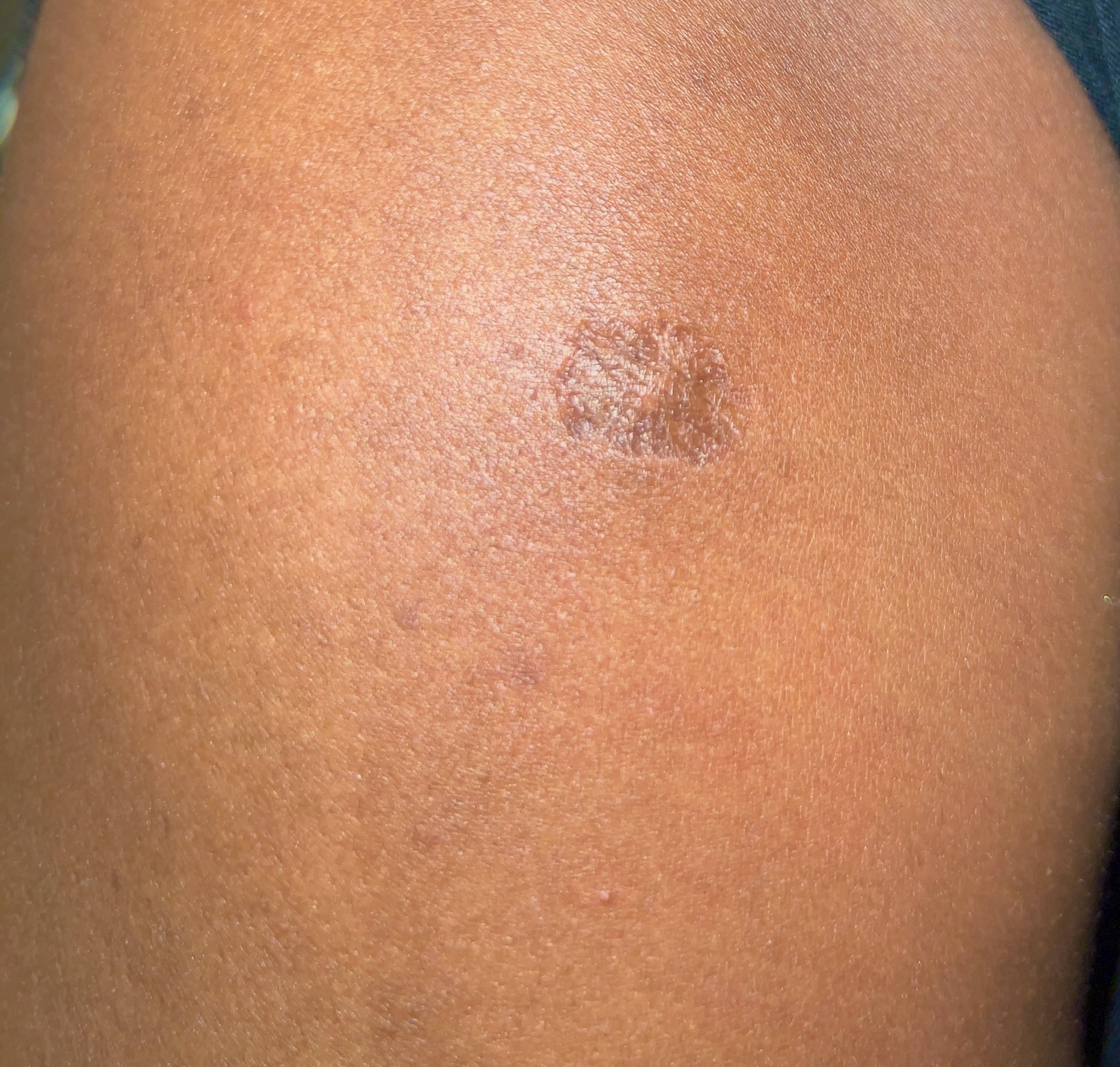 ringworm african american