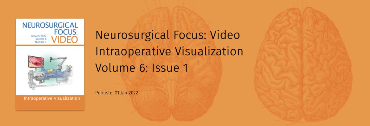 Costas Hadjipanayis (@hadjimdphd) on Twitter photo Happy new year to all! Want to showcase a wonderful new issue of JNS Neurosurgical Focus Video on Intraoperative Visualization. This issue highlights the most cutting edge technologies we neurosurgeons use in the operating room to "see" better. <a href="/TheJNS/">Journal of Neurosurgery</a>
thejns.org/video/view/jou… Happy new year to all! Want to showcase a wonderful new issue of JNS Neurosurgical Focus Video on Intraoperative Visualization. This issue highlights the most cutting edge technologies we neurosurgeons use in the operating room to "see" better. <a href="/TheJNS/">Journal of Neurosurgery</a>
thejns.org/video/view/jou…
