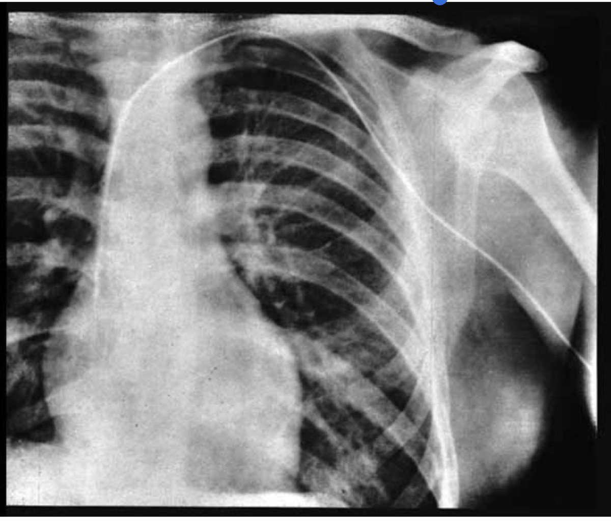 parisjoon's tweet photo. In 1929, The young German surgeon tried a risky unknown procedure on himself.From the crook of his arm he inserted a thin catheter through a vein into his heart and took an X-ray https://t.co/uPdurTBpln 1956 Forssmann shared thNobel Prize in Medicine.#cardiologylove #sciencestar https://t.co/FiA92B3ttH