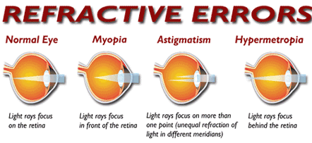 joptoophthal's tweet photo. Refractive error, also known as refraction error, is a problem with focusing light accurately on the retina due to the shape of the eye and or cornea.
#refractiveerror #refractionerror #hazyvision #ptometry https://t.co/NMTsN62T3Z