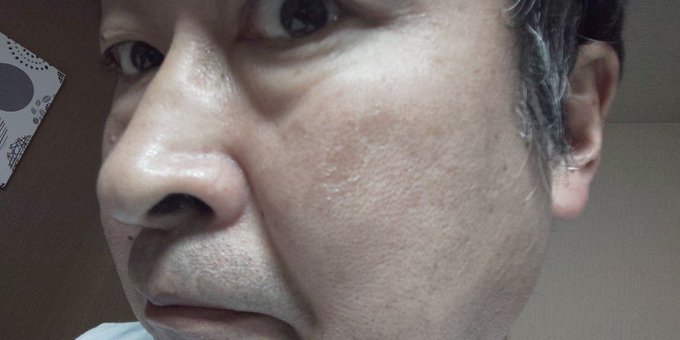 稚内の手前で数時間ブリザードに吹かれた左頬がガサガサになっとった～ 