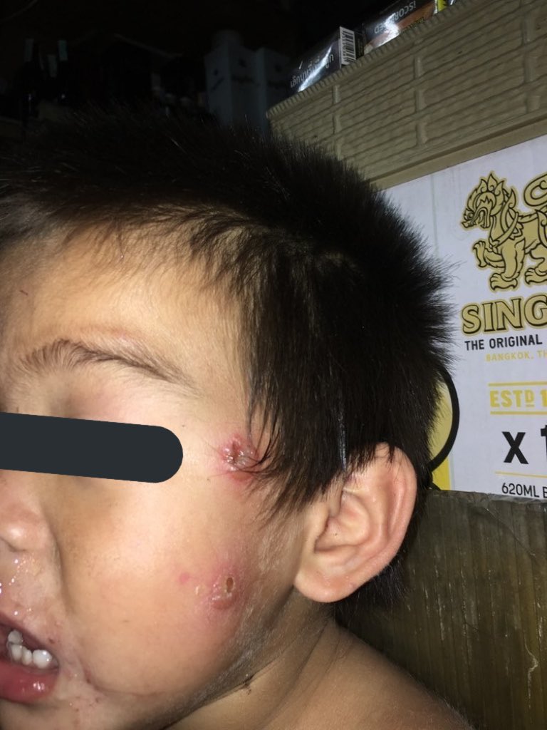 ตัวเองใครมีช่องทางช่วยเหลือน้องได้บ้างเค้าฝากหน่อย ช่วยรีคนละรีก็ได้งับ ขอบคุณทุกคนมากๆนะฮะ🙇🏻‍♀️🙏🏻💖
#ทวิตดีคนรีน้อย