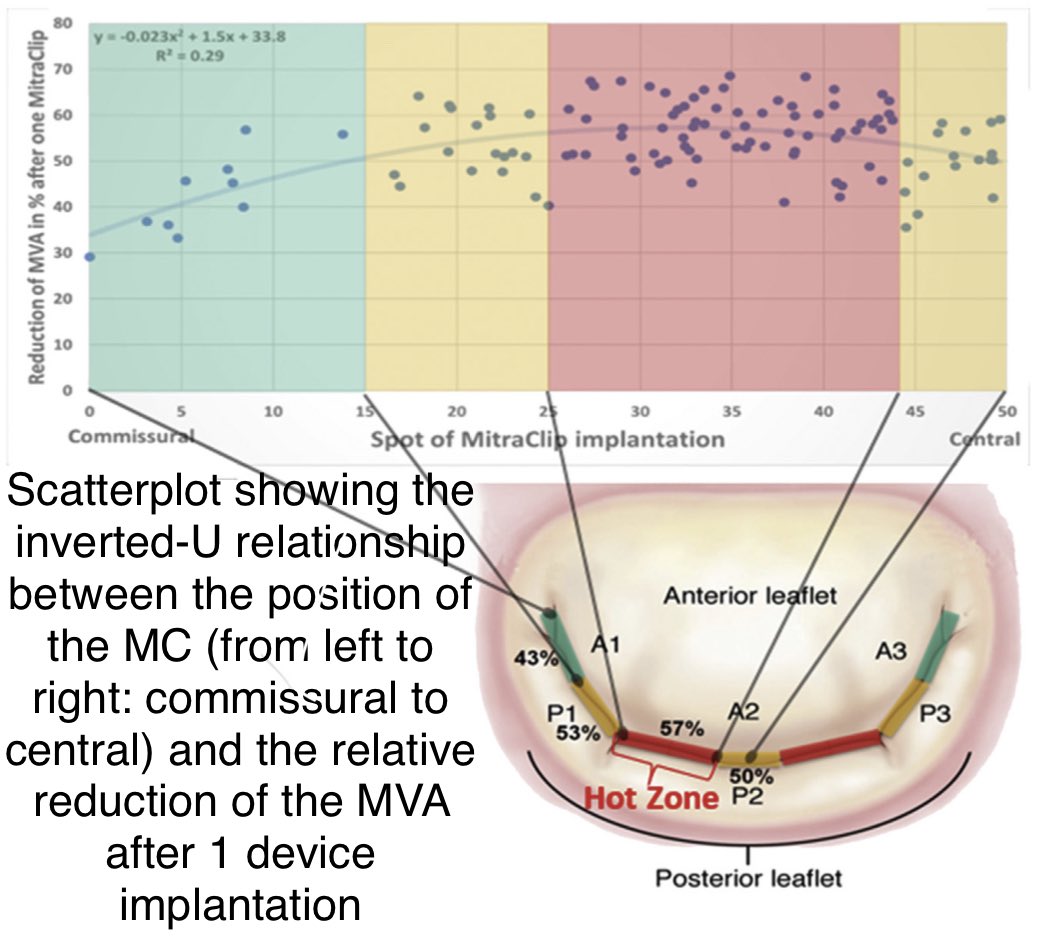 MVA ≥ 4.0 cm2 cutoff expands based on 3D Some w MVA before MC of 3.5 cm2 OK w 1 MC, minimal MVA 4.5 cm2 if 2 MC
tension induced by MC on anterio leaflet due to its U form
center🍃(green) is longer &amp; will be less stretched after MC than lateral/medial more stretched yellow to red
