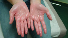 ThyroidTherapy's tweet photo. Multiple Features Help Distinguish #Hyperhidrosis From Normal #Sweating
for more details:https://t.co/KSQ3lmL7Ac https://t.co/QxFwEj2c1P