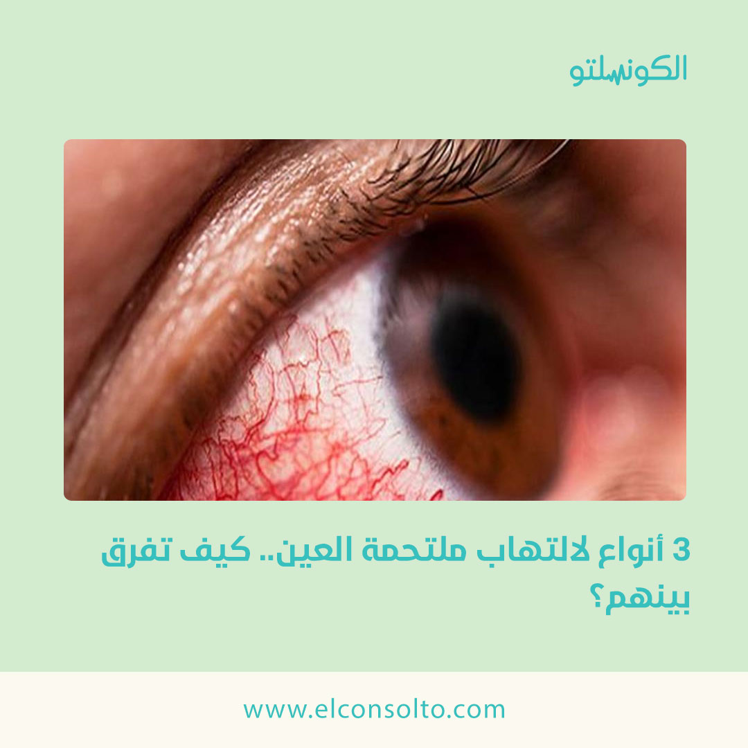 التهاب ملتحمة العين