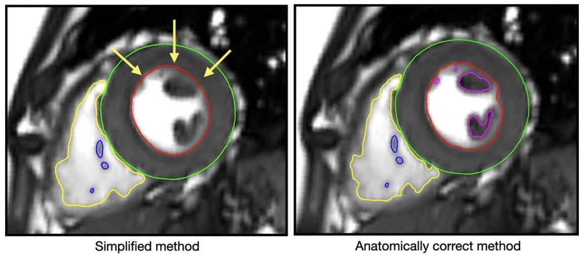 mgwfriedrich's tweet photo. New cardiac MR reference values are out! Normal ranges for cardiac volumes, mass, and function from >3,000 multi-ethnic participants of the Canadian Alliance cohort, using anatomically correct contours. A new standard (don't miss the supplement!).
https://t.co/GUijvOI0F2
#whyCMR https://t.co/HqKGBkDRo7