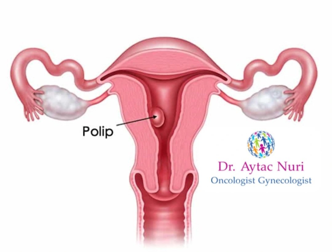 draytac009's tweet photo. UŞAQLIQ POLİPLƏRİ NƏDİR? #uterinepolyp #uşaqlıqpolipi #полипматки #rahimpolipi https://t.co/3lso5HS163