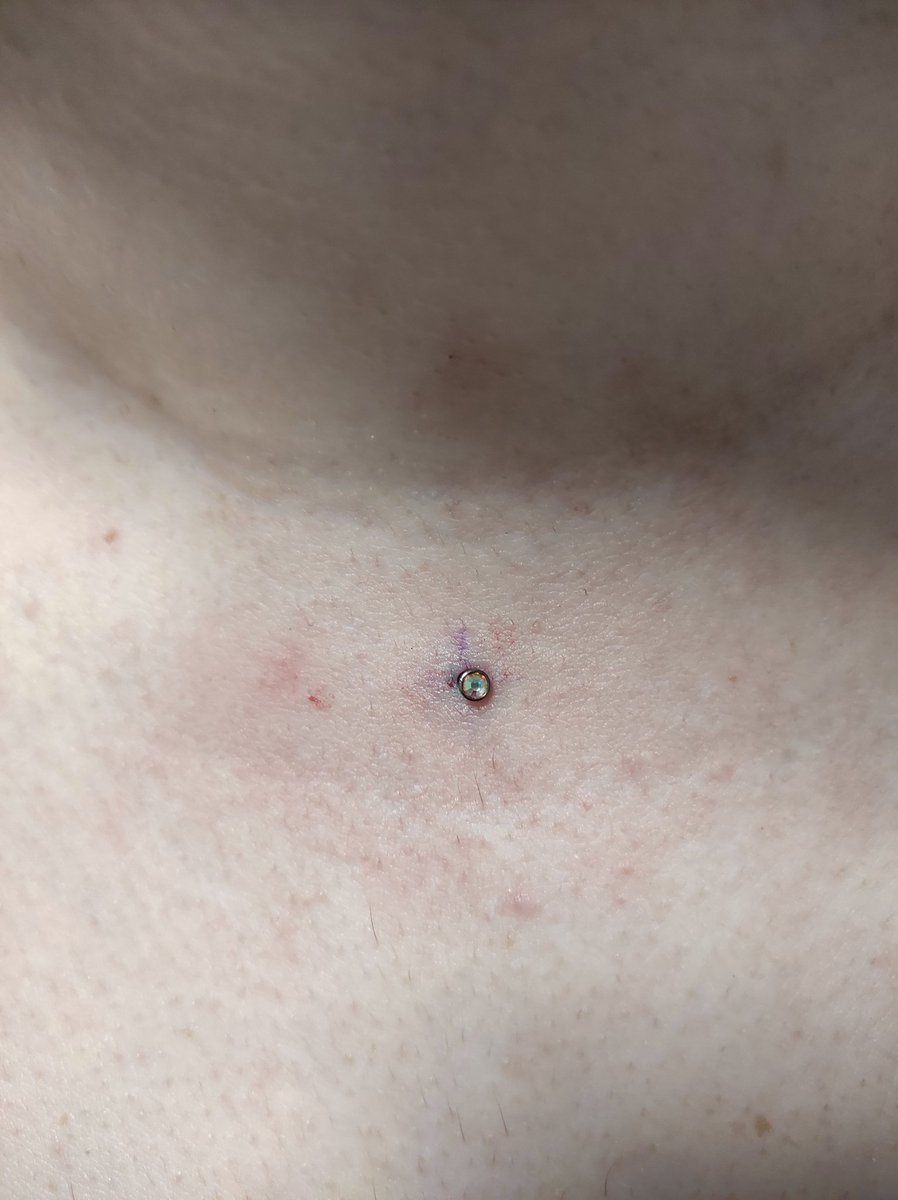 Pedrogomez46's tweet photo. #microdermal https://t.co/tKxYaWyeNl