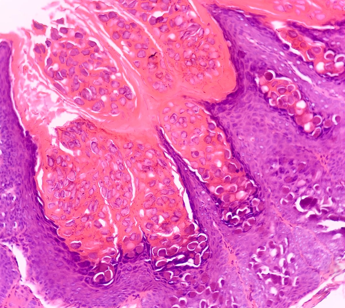 Happy New Year from this year's favorite pox!
Molluscum contagiosum:
-Central depression (often)
-Endophytic lobular hyperplasia
-Intracytoplasmic inclusions (Henderson-Patterson bodies)
-Can have numerous large CD30+ lymphocytes (pseudolymphoma alert!)
#pathtwitter #dermpath