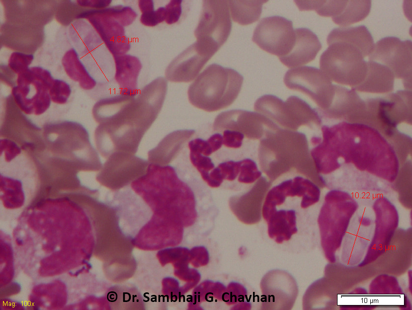 Vet_Pathologist's tweet photo. Canine Hepatozoonosis: Dog, Labrador, Male, 5 Yrs. H/o. Fever, M/M Congested, Salivation, Tick Infestation, continuous muscle twitching and Swollen Lymph Nodes. Blood Smear showed Numerous Hepatozoon spp. gamonts present in neutrophils. #eClinPathCU, #VetClinPath https://t.co/5Dsnze45oO