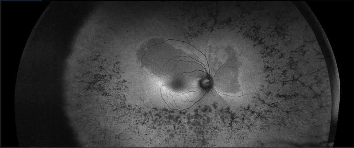 RetinaSERV's tweet photo. 👩⚕️ 🗞️ La Dra. Claudia García Arumí presentó las aportaciones de la imagen del campo amplio a nuestra consulta diaria. Resaltó el uso de la autofluorescencia en distrofias de la retina y el de la AGF de campo amplio en patología vascular. #SERV40 https://t.co/c4DI7cW9Ew