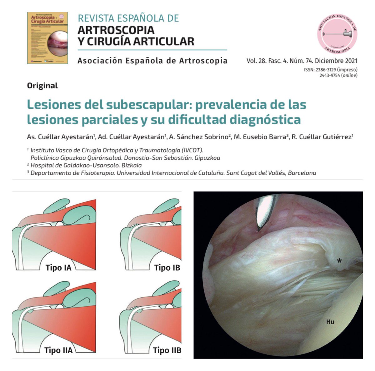 aeartroscopia's tweet photo. 🟣NUEVO ARTÍCULO REACA🟣

✅ Lesiones del subescapular: prevalencia de las lesiones parciales y su dificultad diagnóstica

▪️ Se presenta una nueva subclasificación para un mejor enfoque de su tratamiento quirúrgico. https://t.co/6n8ent88AW
