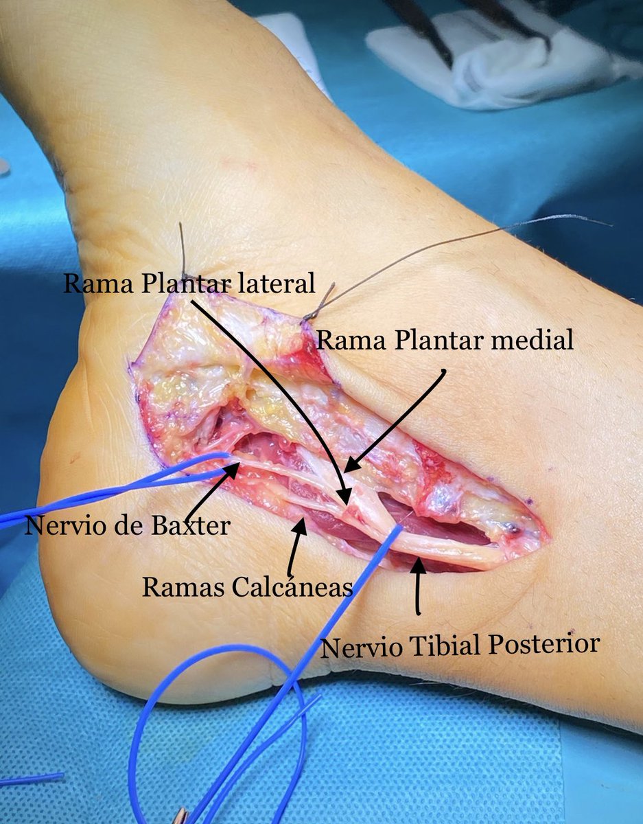 🔴SÍNDROME TUNEL TARSIANO🔴

▪️Dolor retromaleolar medial irradiado en ocasiones a zona plantar medial y dedos.

▪️Diagnóstico: RMN, EMG

🟢TTO: si fracasa manejo conservador, liberación nerviosa de dicho canal.

🔵Imagen anatómica de las ramas nerviosas del Nervio Tibial Post