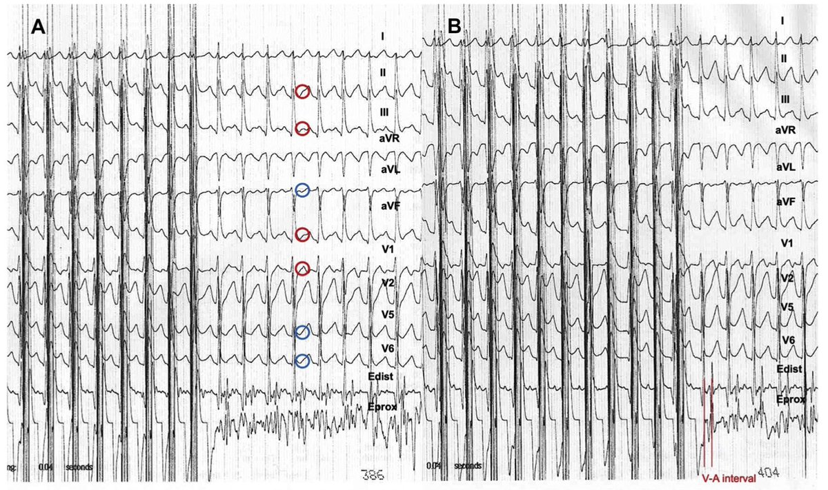 2:1 Pulsus and electrical alternans during atrioventricular reciprocating tachycardia in a healthy young man: A case report heartrhythmcasereports.com/article/S2214-…
