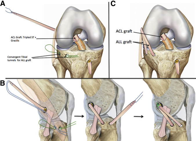 Check out this new technique for combined ACL and ALL reconstruction with a single gracilis autograft #ortho #acl ow.ly/rS0050Hk9Tk