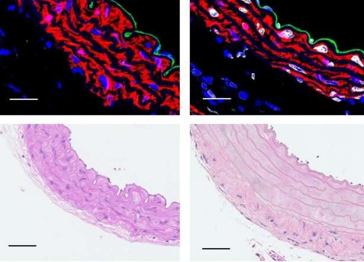 It's never too late to treat progeria, say researchers

medicalxpress.com/news/2021-10-l…

ahajournals.org/doi/10.1161/CI…