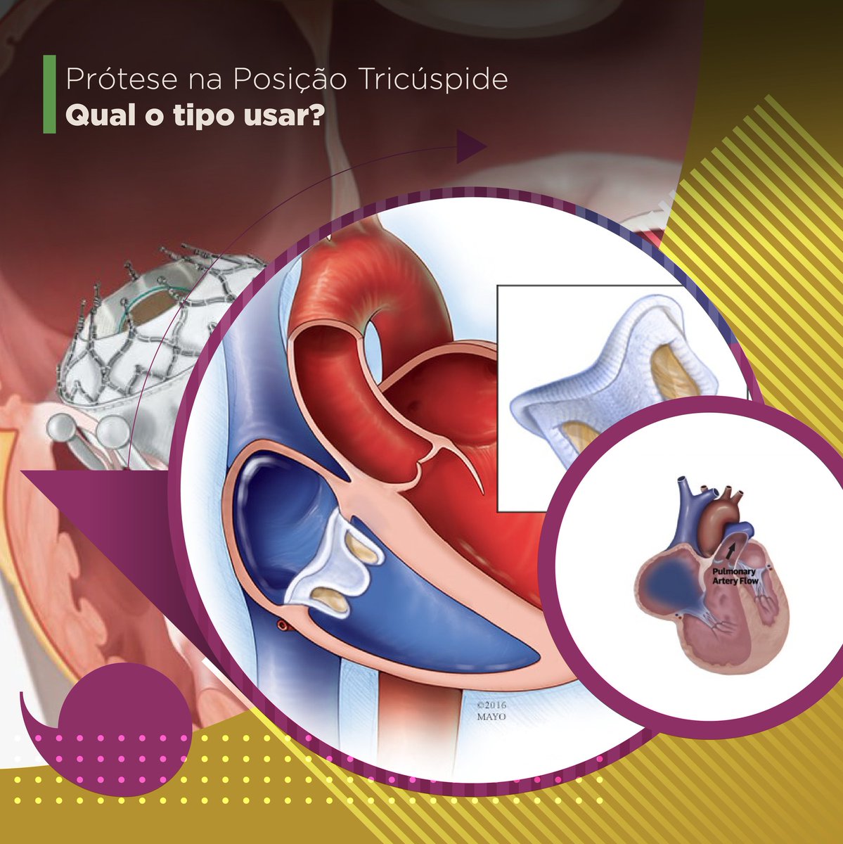 Valve prostheses are fundamental devices in the correction of severe valve diseases, but they bring a series of inherent risks.
.
In the tricuspid position they can be even more complex. Do you know of these complications?
.
Go to thevalveclub.com.br
