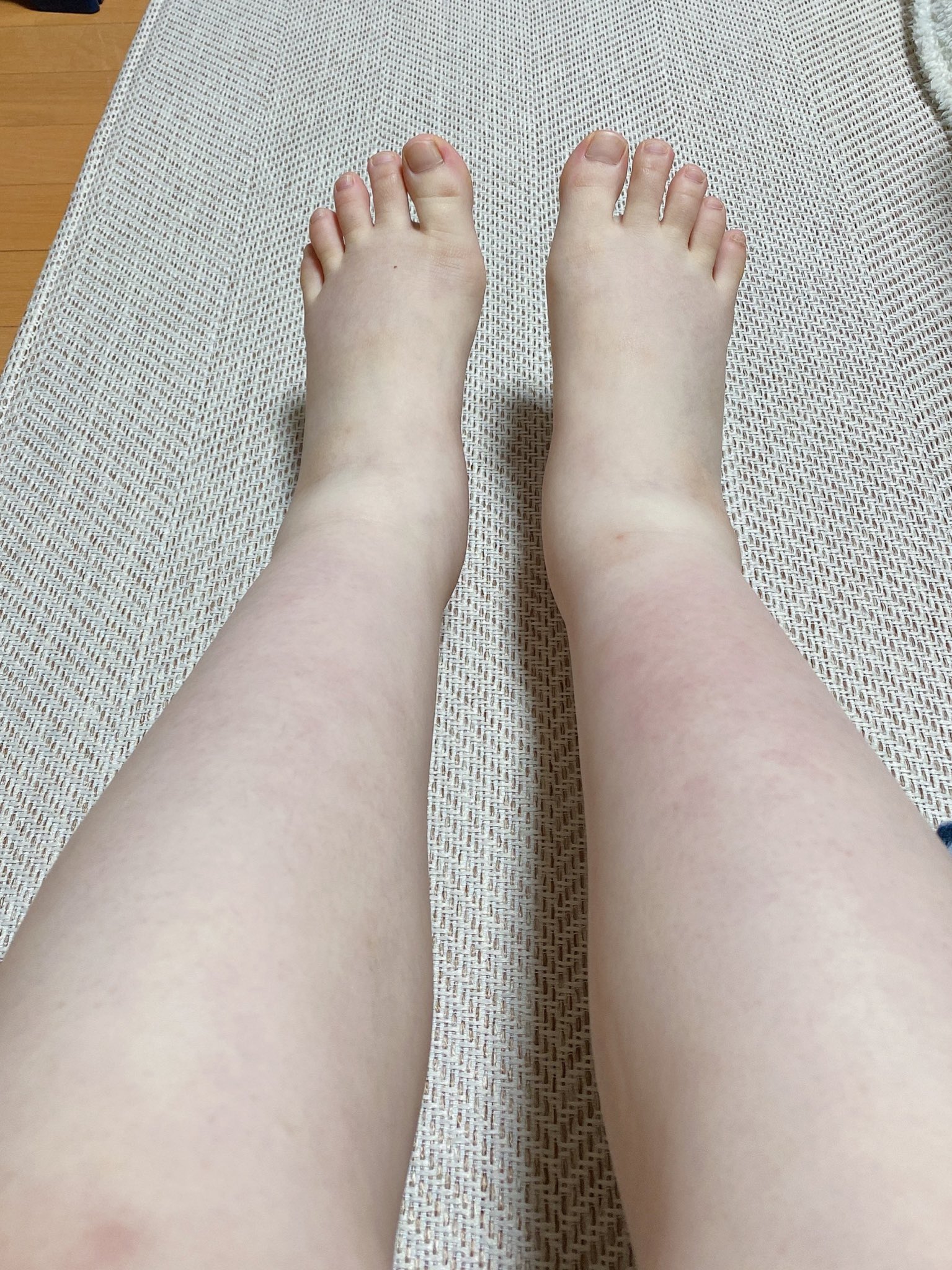 ほのか 臨月の浮腫恐るべし 痛い 痛いぞぉ T Co J2qh3zz4su Twitter