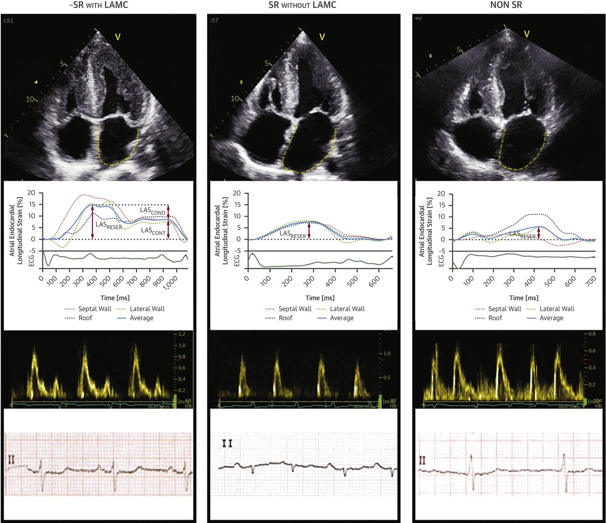 Clinical Importance of LA Infiltration in ATTR #Amyloidosis

The LA involvement in ATTR-CM is not limited to chamber dilatation but implies the loss of physiological function (reservoir, conduit &amp; contraction) related to ⬆️ stiffness chamber jacc.org/doi/10.1016/j.… <a href="/JACCJournals/">JACC Journals</a>