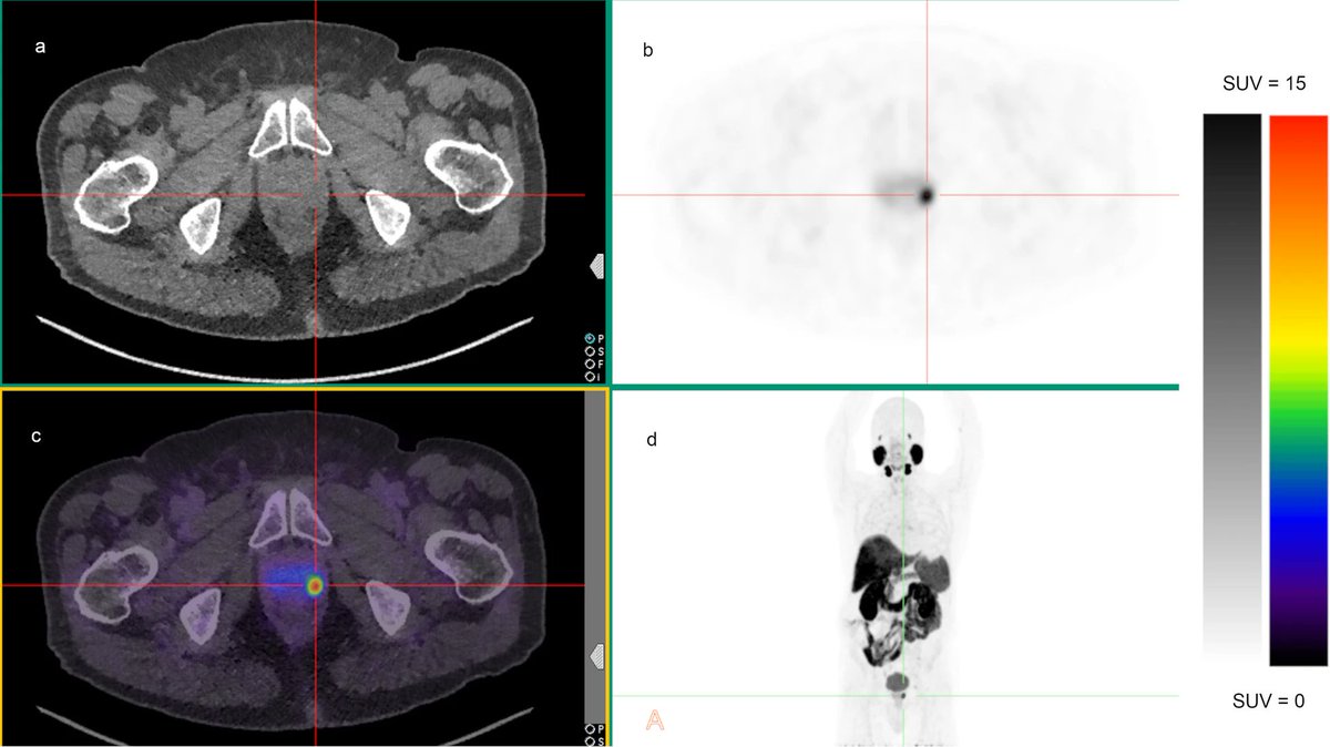 Chikatamarla, V.A. Risk of metastatic disease using [18F]PSMA-1007 PET/CT for primary prostate cancer staging. EJNMMI Res 11, 128 (2021). doi.org/10.1186/s13550…