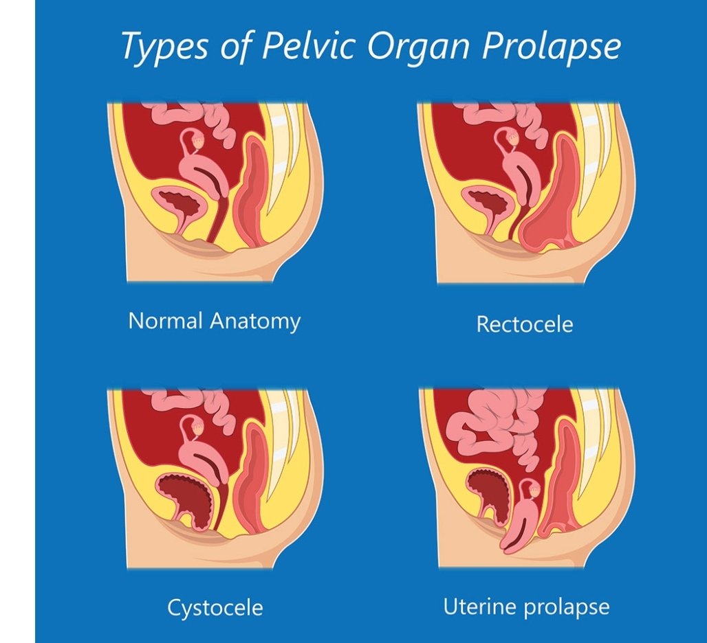 uterine prolapse, prolapsed uterus