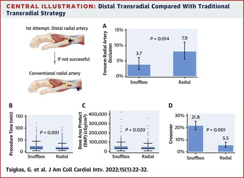 GregorySgueglia's tweet photo. ANGIE just published in #JACCINT

Another RCT showing that distal radial access leads to a lower rate of forearm RAO compared to conventional #RadialFirst

Evidence continues to build up quickly. Kudos!

https://t.co/5xpmweUgzW

#dTRA #ldTRA #ldTRI #rdTRA #rdTRI https://t.co/0eAiehkSD6