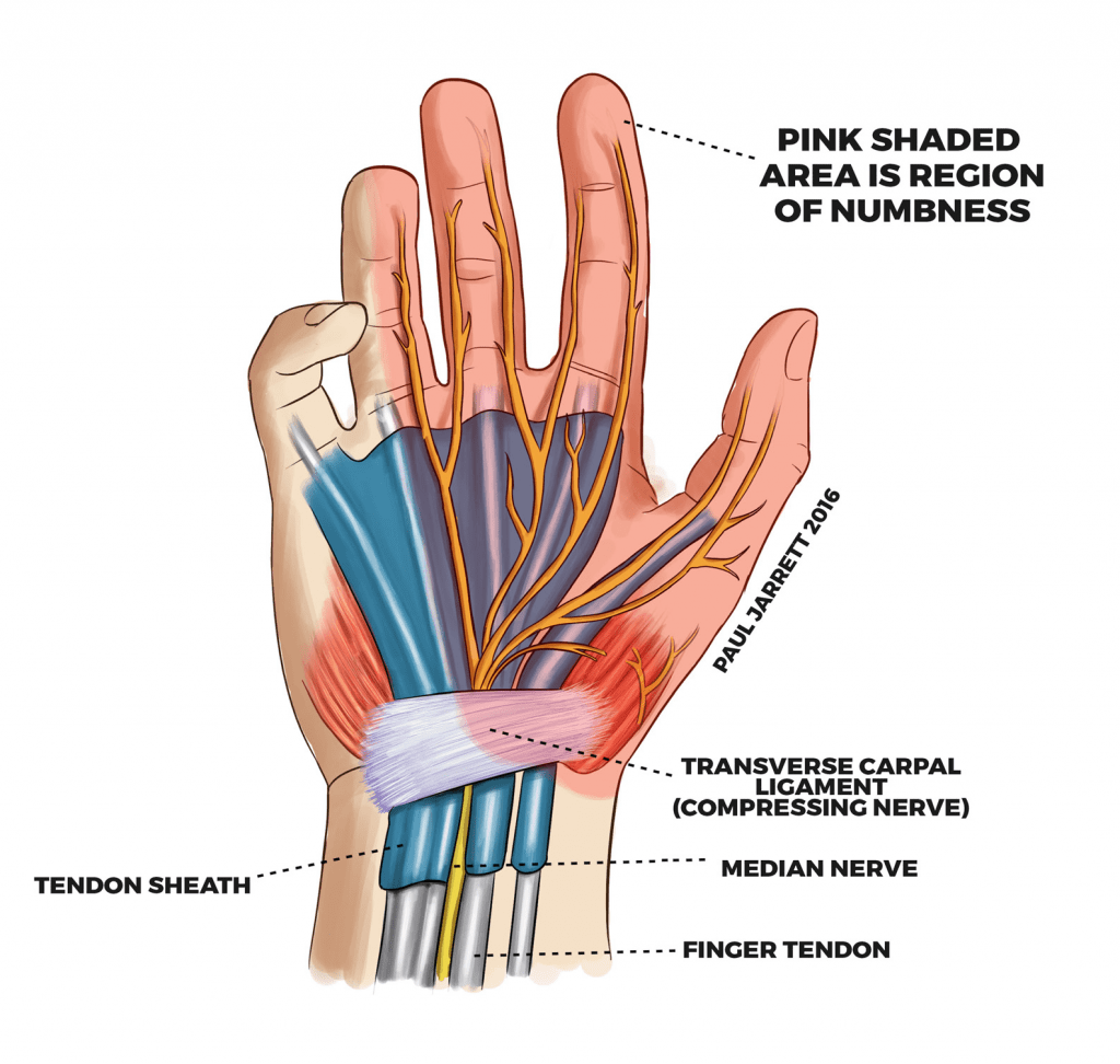 Пальцы колет иголками. Анатомия срединного нерва на кисти. Синдром запястного канала запястье. Туннельный синдром запястья кисти фото. Туннельный синдром пальцев руки.