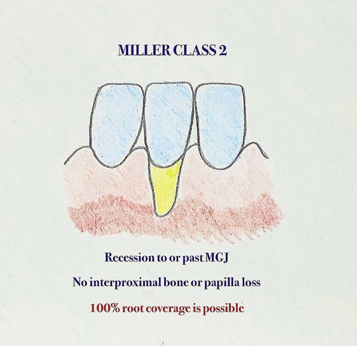 Gingival Recession Classification