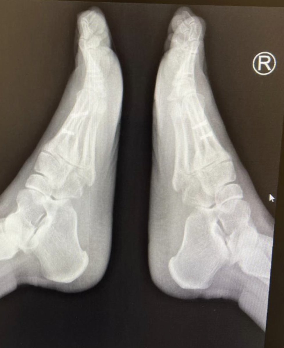 MedorthoMs's tweet photo. What is the suitable osteotomy could I do in her case ?
Shall I remove the old screws ?
Thanks https://t.co/WEs97t9ZCq