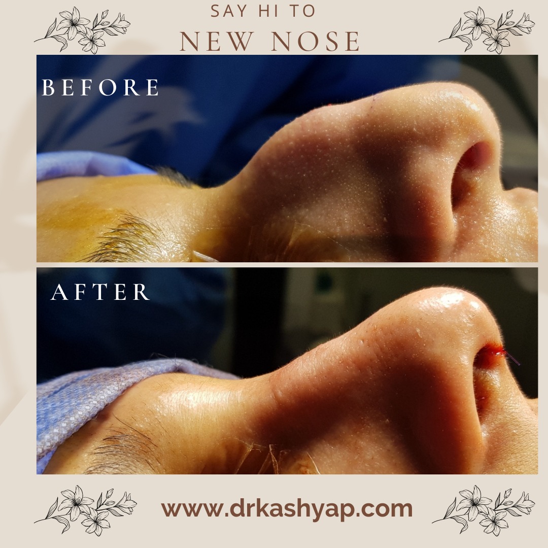 Drajayakashyap's tweet photo. On-table #rhinoplasty result. Look at him immediately after the #nosesurgery.
Call or DM for a Vectra 3D Imaging Consultation to see your future results.
✅ Email: info@bestrhinoplastyindia.com
#piezoelectricrhinoplasty #ultrasonicrhinoplasty #cosmeticprocedure #ontable https://t.co/yhfEakYoZB