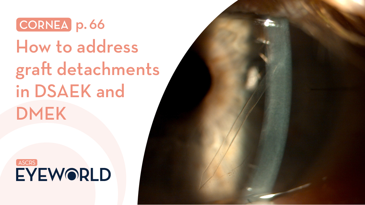 Graft detachments are a fairly common complication with DMEK and DSAEK. In this article, Amy Lin, MD, and Francis Price Jr., MD, discuss when they are more likely to happen and how to handle them - bit.ly/3q7jWVl 
#EyeWorldMagazine #Cornea #ophthalmology