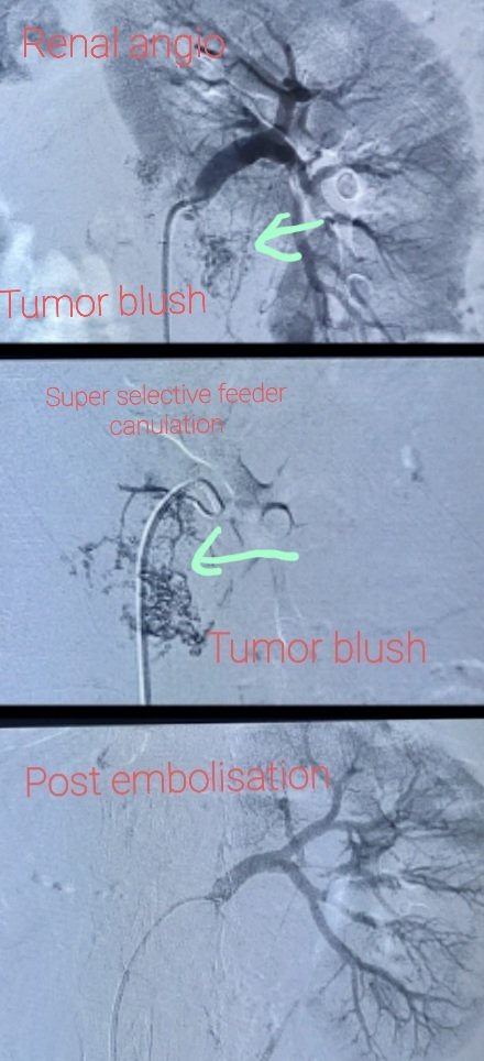 Superselective embolotherapy to cure 4 cm  renal angiomyolipoma in solitary kidney, preserving maximum of normal renal parenchyma in a young lady with tuberous sclerosis. 
#interventionalradiology
#angiomyolipoma
#embolotherapy
#tuberoussclerosis