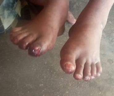 mdaftab117's tweet photo. Inhumane Custodial Torture of Mr Amanat Hussain and his wife at Balidih PS without any evidence is unacceptable and cannot be tolerated in any civilised society @IrfanAnsariMLA @HemantSorenJMM 
@BokaroDc
@Alamgircongress
@bokaropolice https://t.co/v1xzrkH3XQ