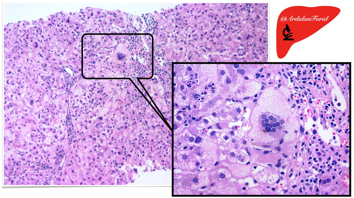 ArdalanFarid's tweet photo. A 32-year-old lady with a history of #liver_transplantation three years ago. Now, she has presented with #jaundice, markedly elevated #transaminases, and mildly elevated #alkaline_phosphatase. What are the salient #histopathologic findings? #Diagnosis?
#PathTwitter
#TUMSpath https://t.co/QAbJO4cRI7