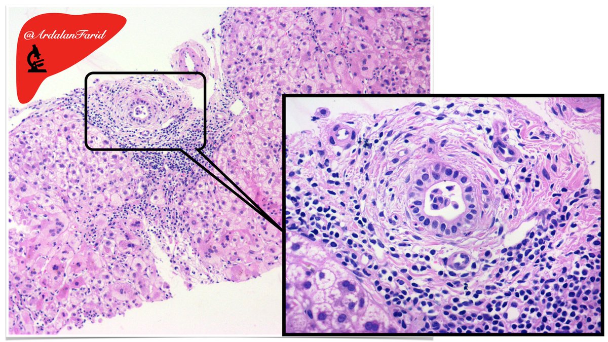 ArdalanFarid's tweet photo. A 32-year-old lady with a history of #liver_transplantation three years ago. Now, she has presented with #jaundice, markedly elevated #transaminases, and mildly elevated #alkaline_phosphatase. What are the salient #histopathologic findings? #Diagnosis?
#PathTwitter
#TUMSpath https://t.co/QAbJO4cRI7