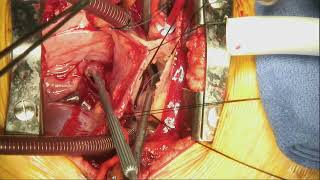 CTSNet (@ctsnetorg) on Twitter photo Repair of Partial Anomalous Pulmonary Venous Return (Scimitar Vein) via Interposed Polytetrafluoroethylene (PTFE)
By <a href="/WMMitchell/">William Mitchell</a>
ctsnet.org/article/repair… Repair of Partial Anomalous Pulmonary Venous Return (Scimitar Vein) via Interposed Polytetrafluoroethylene (PTFE)
By <a href="/WMMitchell/">William Mitchell</a>
ctsnet.org/article/repair…