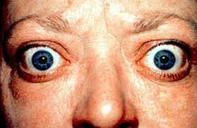ThyroidTherapy's tweet photo. #Treatments for Medial #Temporal Lobe Volume Loss Caused by #Graves Disease
for more details:https://t.co/reZw0npEO3 https://t.co/biY3OpMFdm