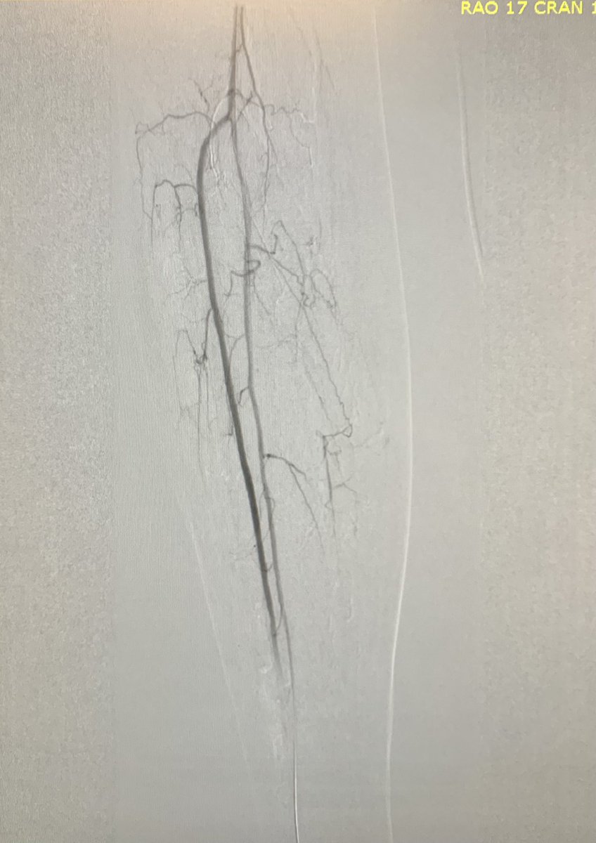ReVascMed (@revascmed) on Twitter photo First #nextgen #Nexcimer #LaserAtherectomy at #PennsyInterventions for a complex peripheral instent occlusion revascularization with <a href="/jcgeorgemd/">Jon George</a> <a href="/PennCVFellows/">Penn Cardiology Fellows</a> <a href="/GPAngioClub/">Phila Angio Club</a> <a href="/ACVCPhila/">Academy for CardioVascular Collaboration</a> <a href="/PhilipsHealth/">Philips Healthcare</a> First #nextgen #Nexcimer #LaserAtherectomy at #PennsyInterventions for a complex peripheral instent occlusion revascularization with <a href="/jcgeorgemd/">Jon George</a> <a href="/PennCVFellows/">Penn Cardiology Fellows</a> <a href="/GPAngioClub/">Phila Angio Club</a> <a href="/ACVCPhila/">Academy for CardioVascular Collaboration</a> <a href="/PhilipsHealth/">Philips Healthcare</a>