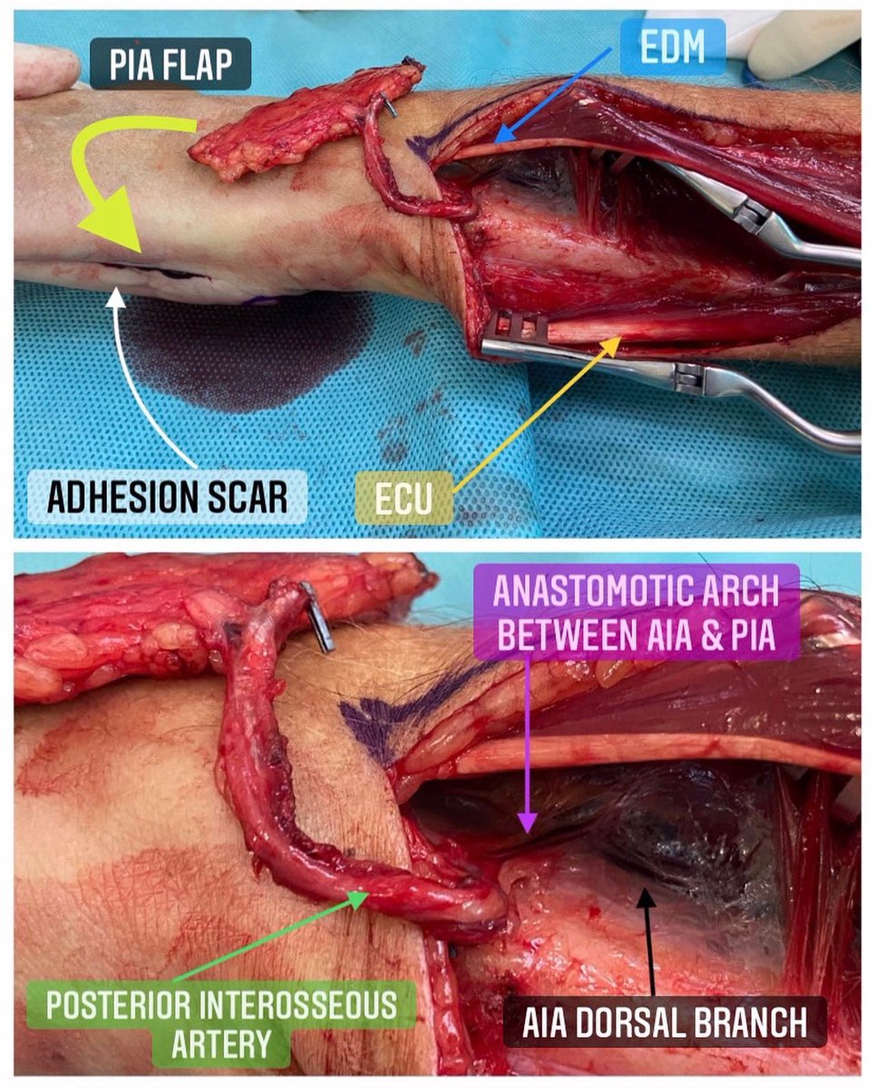 DrBarreraochoa's tweet photo. Anatomía del Colgajo Interóseo Posterior Retrógrado https://t.co/Gi9o9oZBbm