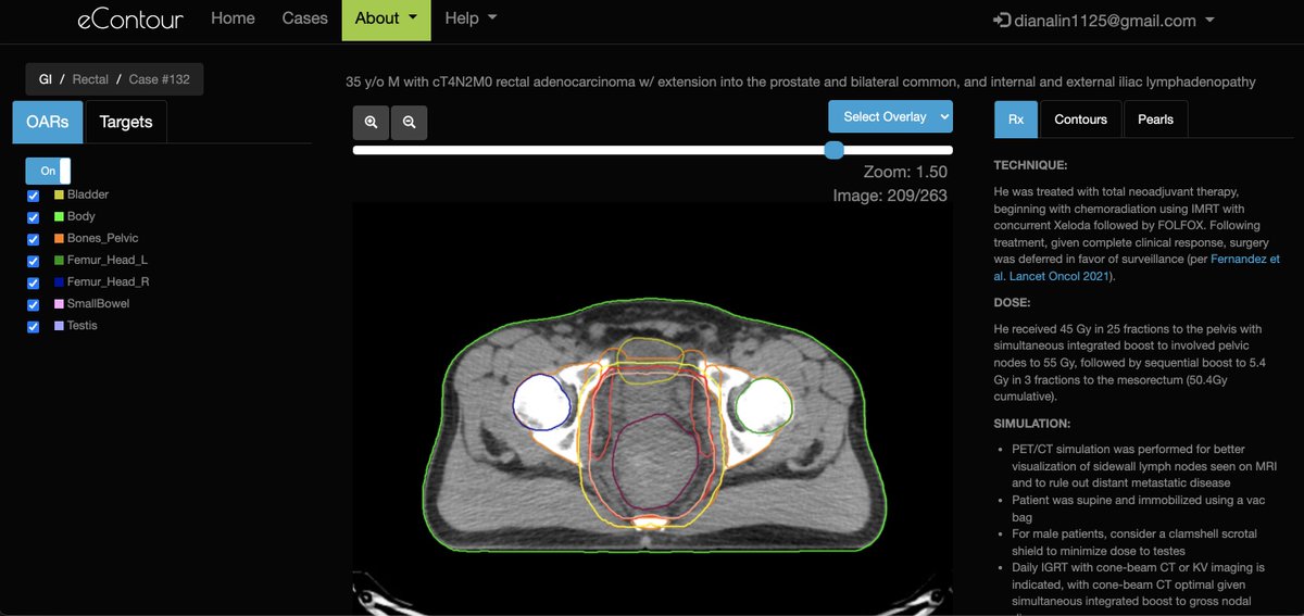 eContourRadOnc's tweet image. We&apos;re excited to 🔔 ring in the new year 🎉 with an all NEW #eContour case, courtesy of @UPMCHillmanCC❗️ 

Take a 👀 at this pre-op node + rectal cancer case now  👉 econtour.org/cases/132

#radonc #meded