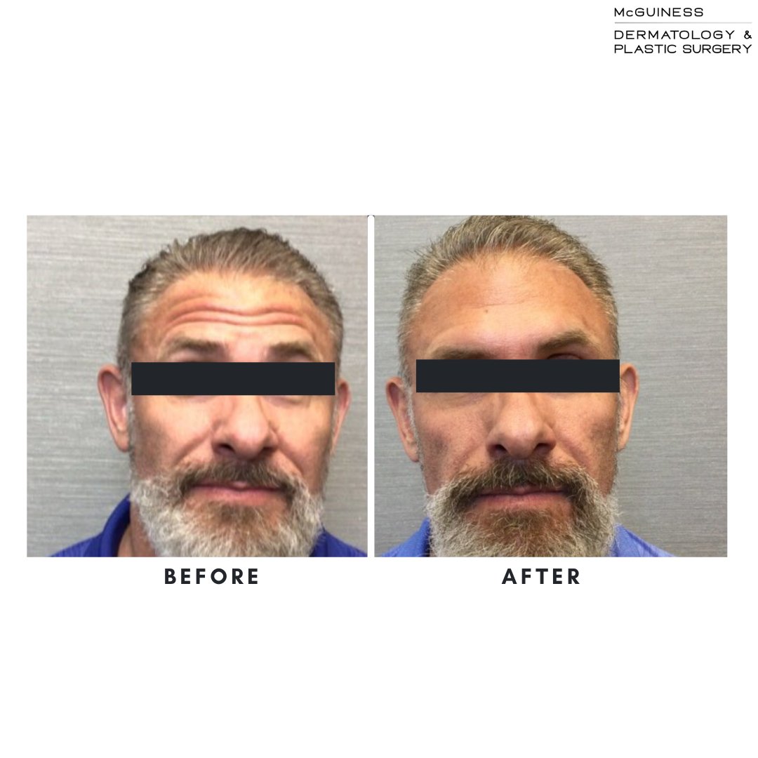 McGuinessDerm's tweet photo. Brotox.... Because men deserve wrinkle-free skin too 💁‍♂️

📍Done by Patrica in Prosper 
📞 Call us today to book your appointment (972)-316-4555
💻 Visit us at https://t.co/xJzzQy72tV for more information on treatments and products https://t.co/wFIJ2gMYRM