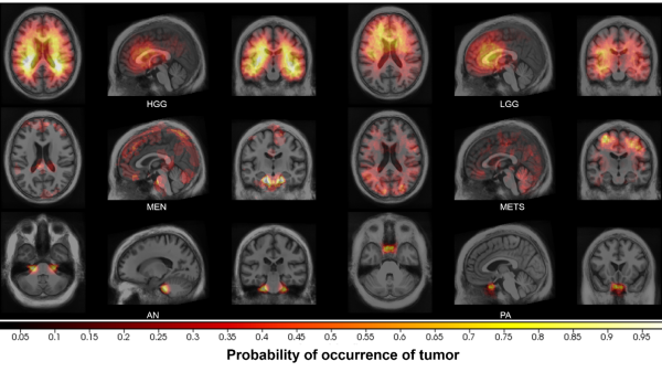 Charles Kahn, MD (@cekahn) on Twitter photo At #5: "MRI-based identification and classification of major intracranial tumor types by using a 3D convolutional neural network"
doi.org/10.1148/ryai.2… from <a href="/MIRimaging/">WashUMedMIR</a> <a href="/Satrajit_C/">Satrajit Chakrabarty</a>
#NeuroRad #DeepLearning #RadAIchat At #5: "MRI-based identification and classification of major intracranial tumor types by using a 3D convolutional neural network"
doi.org/10.1148/ryai.2… from <a href="/MIRimaging/">WashUMedMIR</a> <a href="/Satrajit_C/">Satrajit Chakrabarty</a>
#NeuroRad #DeepLearning #RadAIchat
