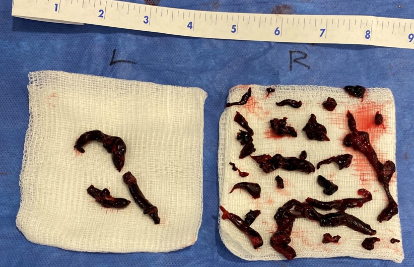 A good day when your 89yo PE pt can leave the angio suite telling jokes after pulmonary thrombectomy. Just 1 hr before w. RV strain, hypotension &amp; ⏫ lactate #FlowTriever #IRad