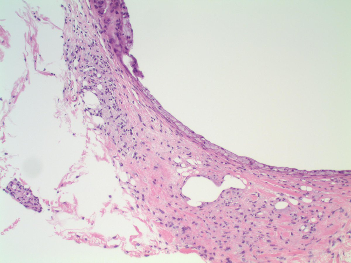 slusagar's tweet photo. especially for the #pathnewbies who might have not heard this term before in #breastpath:
"membranous fat necrosis" (basically cystic/fibrillar pattern fat necrosis) https://t.co/1FpcPD7fHR