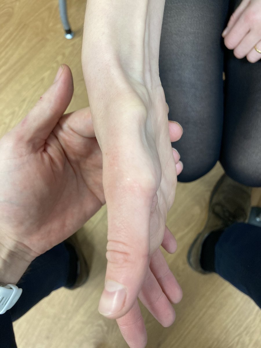 TJQPNI's tweet photo. Gilliatt-Sumner hand is a term for a loss of both median and Ulnar intrinsics with intact median sensation as is seen her (with consent) in a patient with a longstanding undiagnosed thoracic outlet compression #TOS https://t.co/YQSwzCkXGv