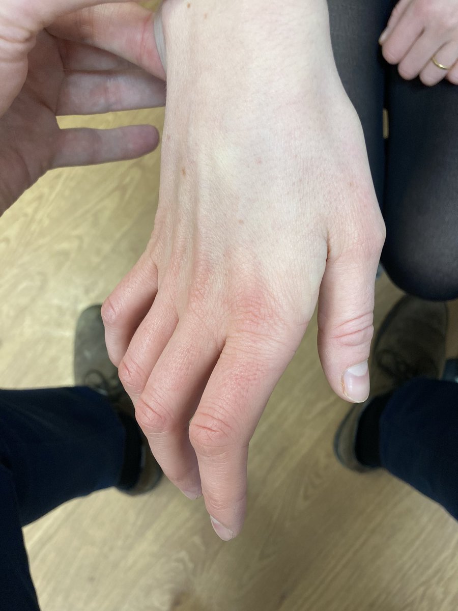 TJQPNI's tweet photo. Gilliatt-Sumner hand is a term for a loss of both median and Ulnar intrinsics with intact median sensation as is seen her (with consent) in a patient with a longstanding undiagnosed thoracic outlet compression #TOS https://t.co/YQSwzCkXGv