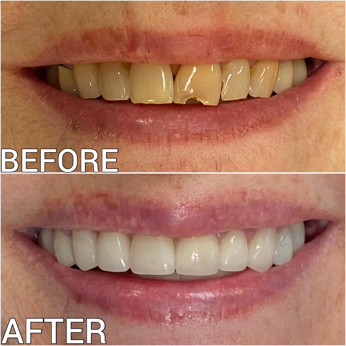 ***TRANSFORMATION TUESDAY***
Dr. Bobby F. Shunnarah had the privilege of treating this very sweet patient.  He completed a full comprehensive dental plan involving 2 upper back right implant crowns, 8 EMAX crowns across the top, a lower right three-unit bridge and teeth whitening