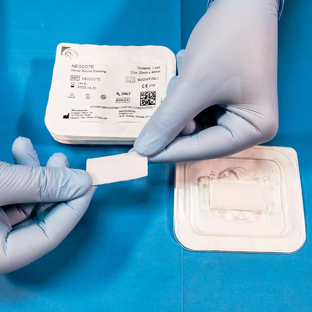 Citagenix's tweet photo. NeoCote is often used in #palatal wounds or oral abscesses. Can also be used on top of a membrane as an external covering, on burns or #periosteal defects. Usally resorb in 1-2 weeks. Meant to be used as #wounddressing, not as membrane. https://t.co/bFSFJHb8K5
#dentistry #dental https://t.co/dsA0TMRQmi